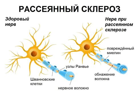 рассеянный склероз передается по наследству|Рассеянный склероз: передается ли по наследству。